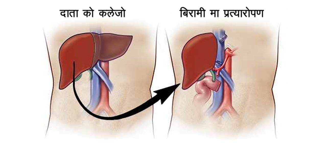 कलेजो प्रत्यारोपणपछिको नयाँ जीवन